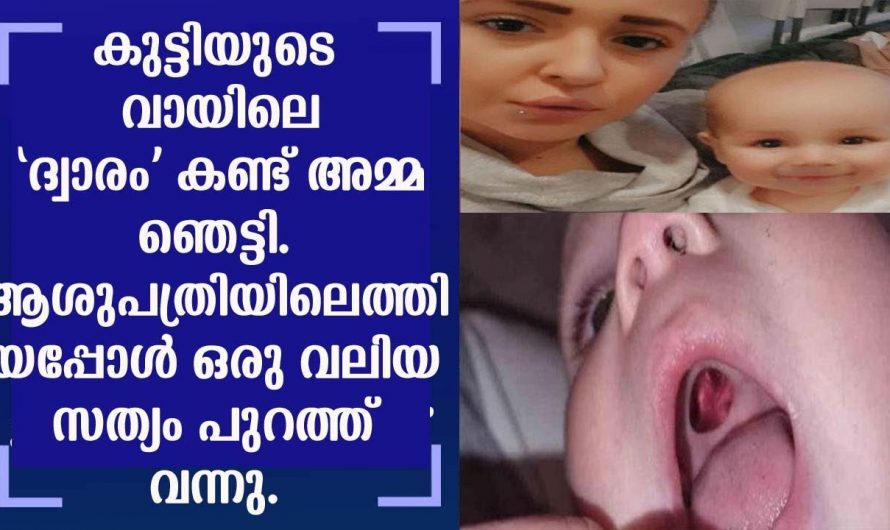 കുട്ടിയുടെ വായയിലെ ദ്വാരം കണ്ടു ഞെട്ടിത്തരിച്ച അമ്മ ചെയ്തത് കണ്ടോ